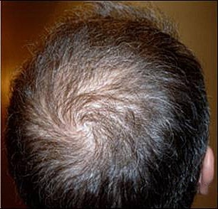 Hair Transplant Before & After