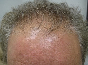 Hair Transplant Before & After
