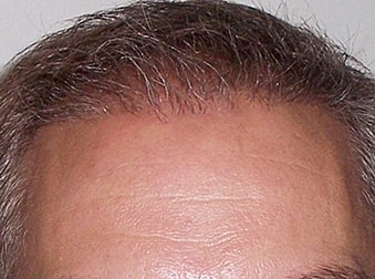 Hair Transplant Before & After
