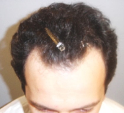 Hair Transplant Before & After