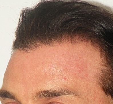 Hair Transplant Before & After