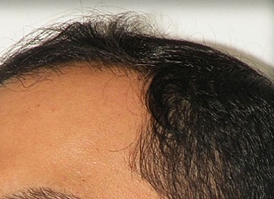 Hair Transplant Before & After