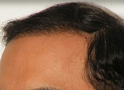 Hair Transplant Before & After