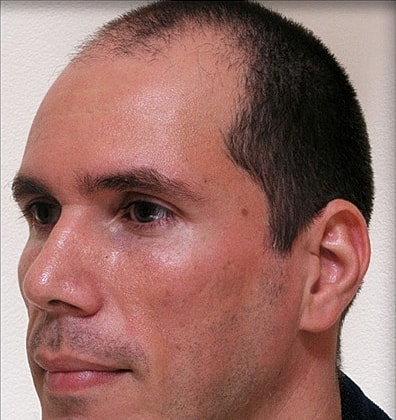 Hair Transplant Before & After