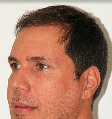 Hair Transplant Before & After