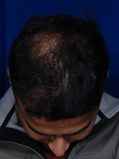 Hair Transplant Before & After