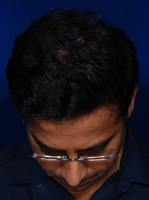 Hair Transplant Before & After