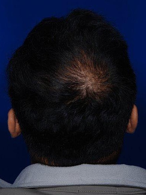 Hair Transplant Before & After