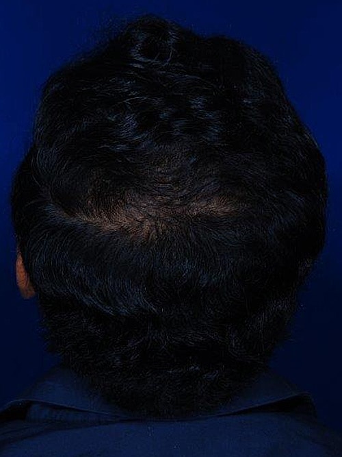 Hair Transplant Before & After