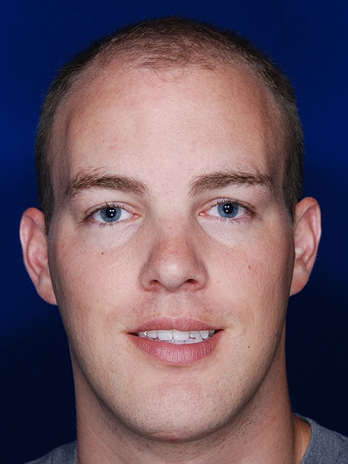 Hair Transplant Before & After
