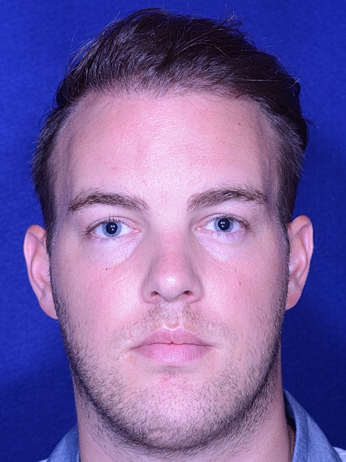 Hair Transplant Before & After