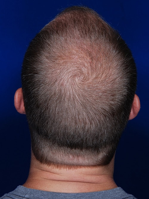 Hair Transplant Before & After