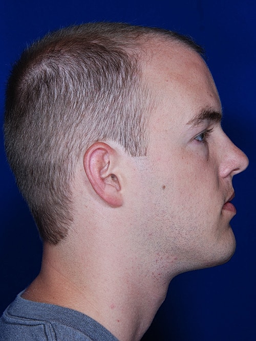 Hair Transplant Before & After