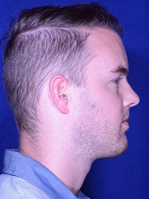 Hair Transplant Before & After