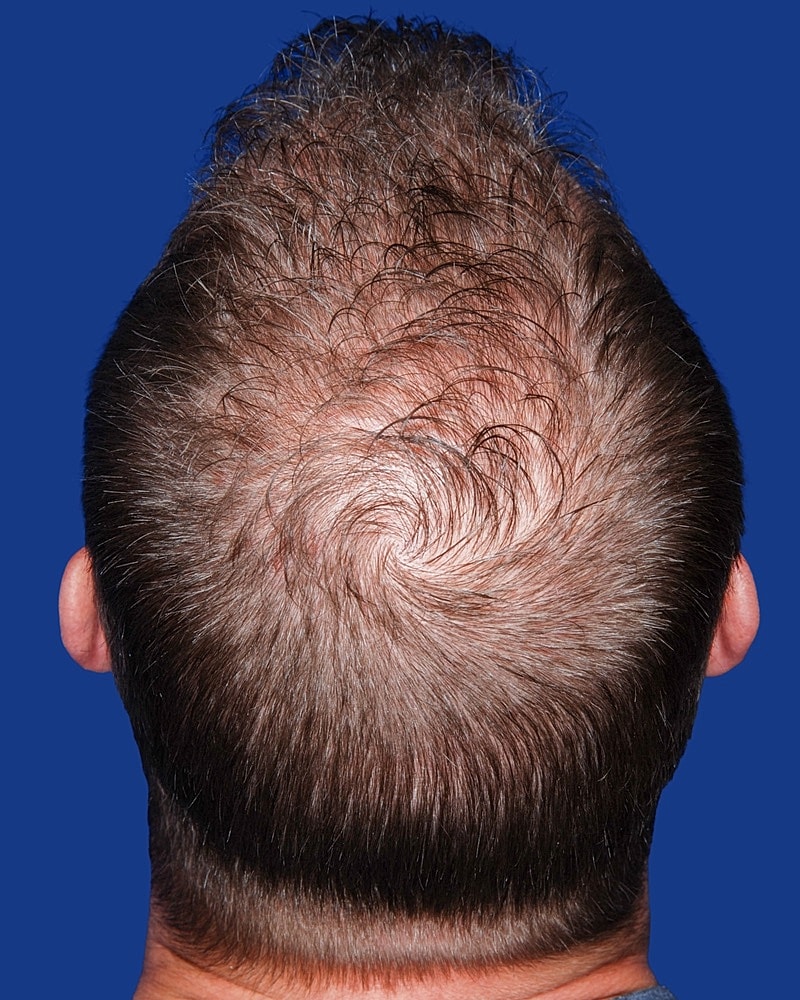 Hair Transplant Before & After