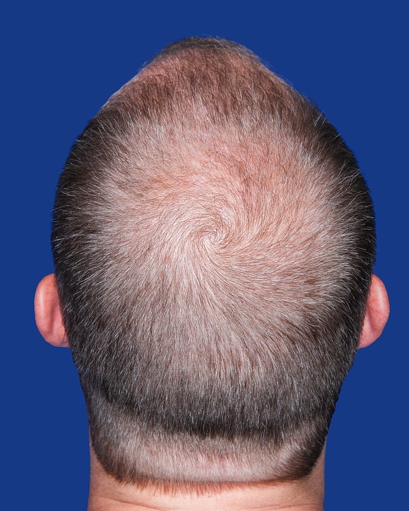Hair Transplant Before & After