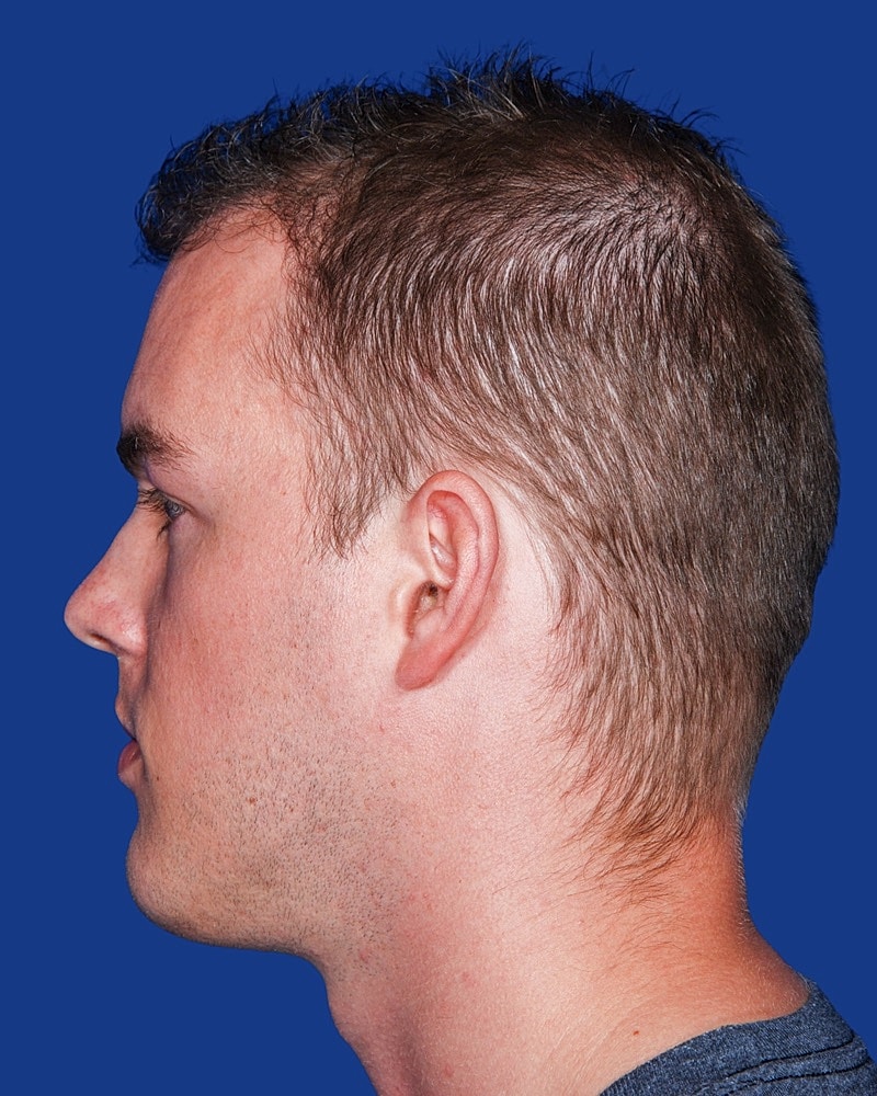 Hair Transplant Before & After