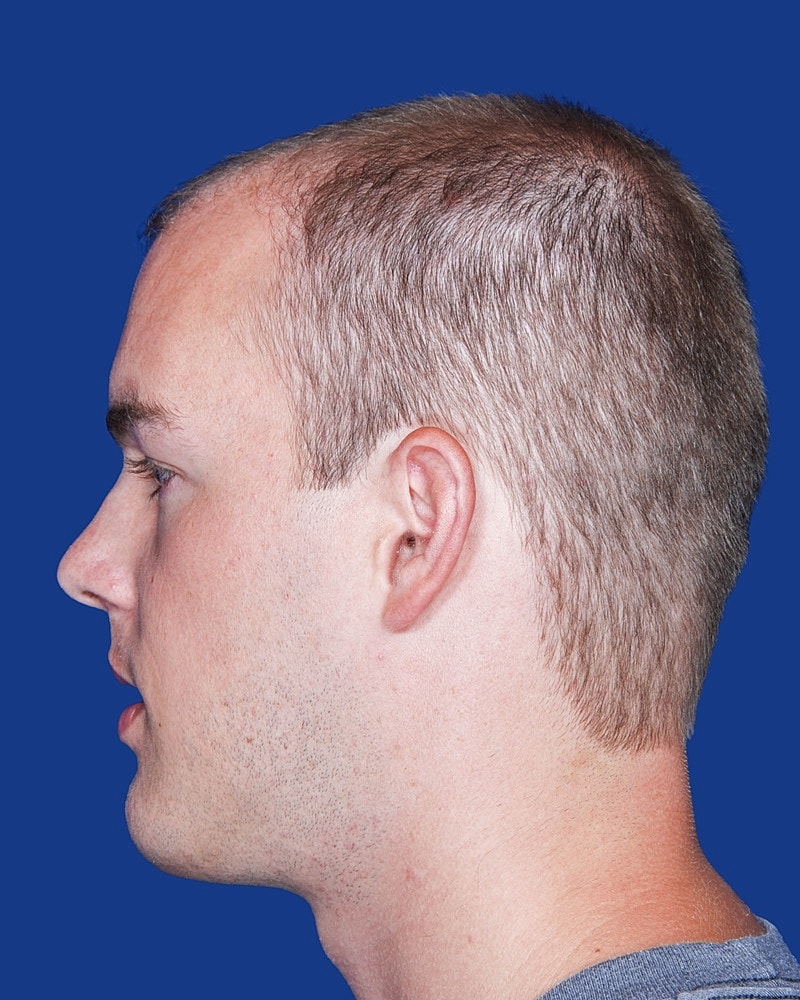 Hair Transplant Before & After