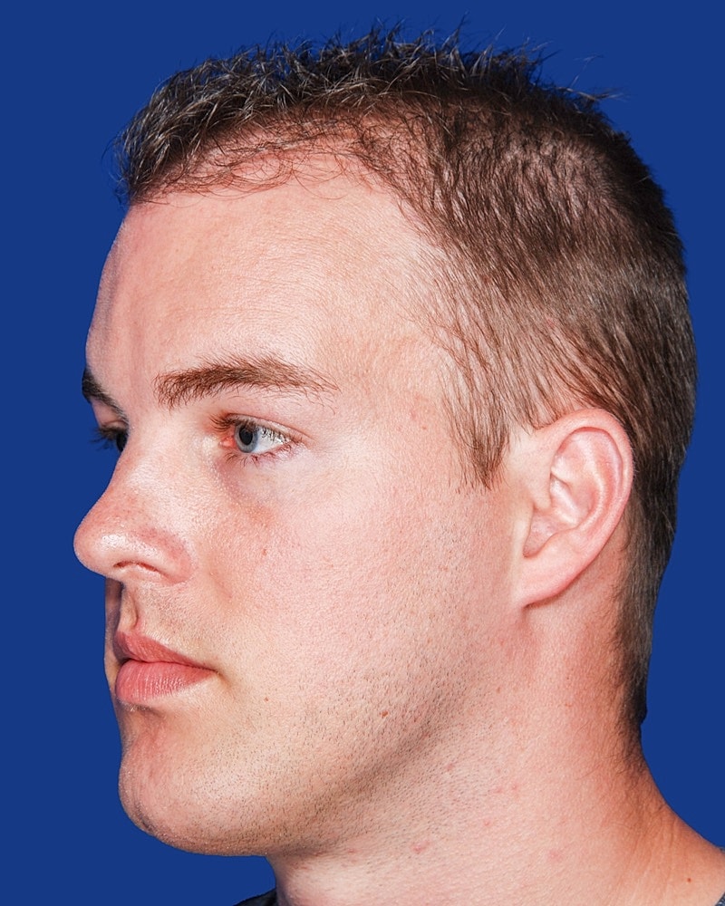 Hair Transplant Before & After