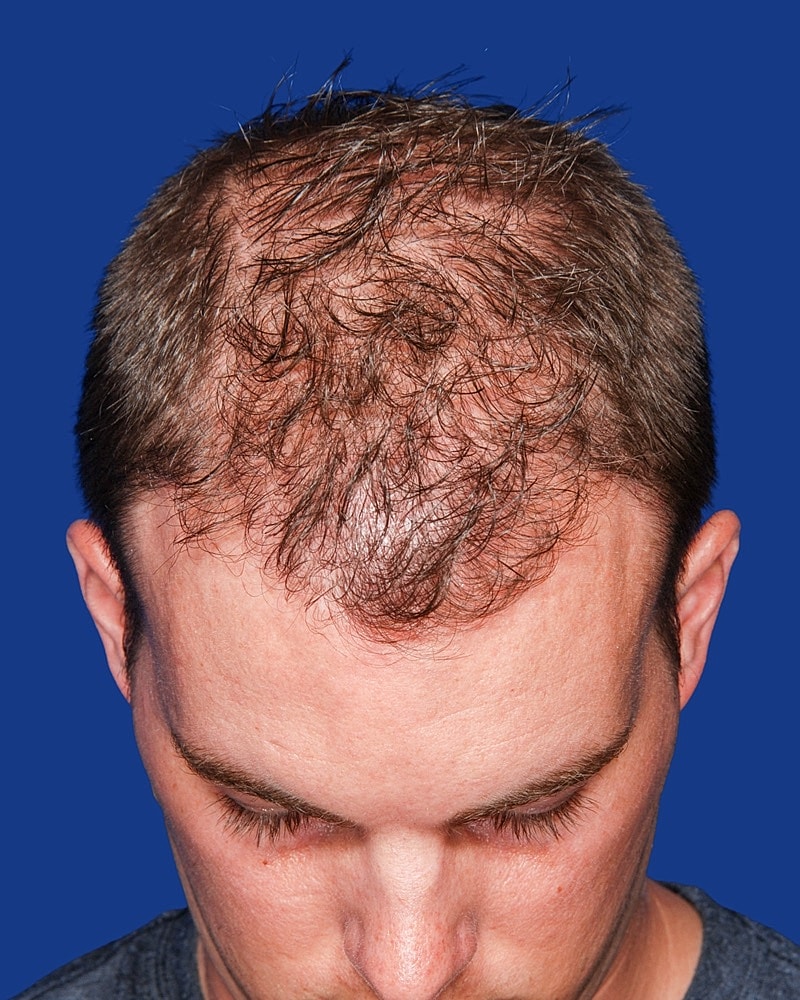Hair Transplant Before & After