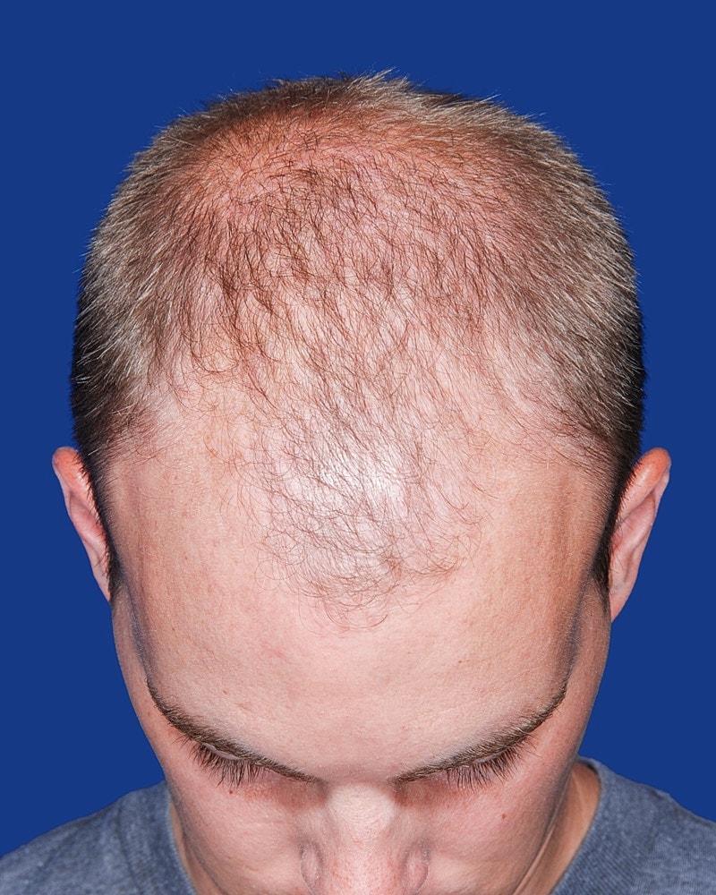 Hair Transplant Before & After