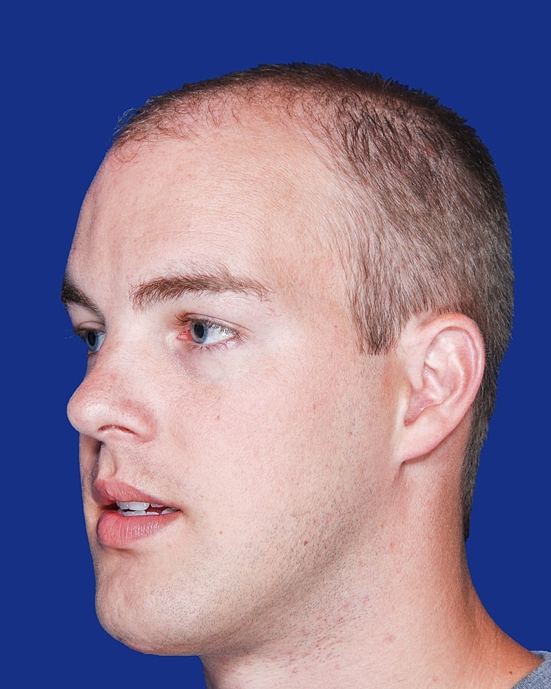 Hair Transplant Before & After