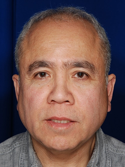 Hair Transplant Before & After