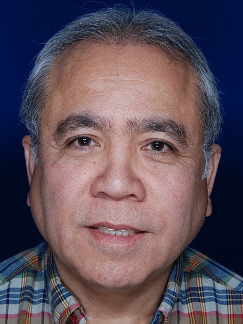 Hair Transplant Before & After