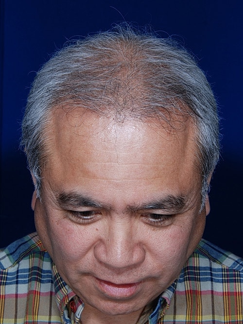 Hair Transplant Before & After