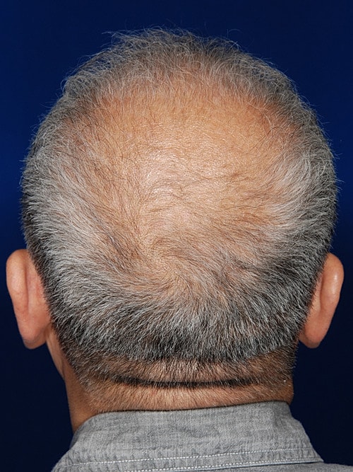 Hair Transplant Before & After