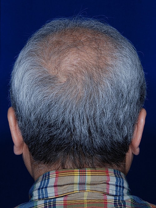 Hair Transplant Before & After