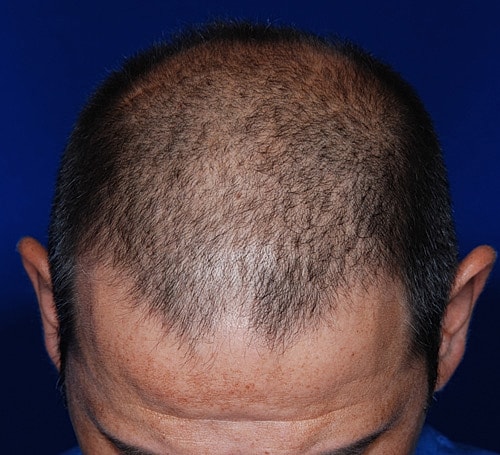 Hair Transplant Before & After