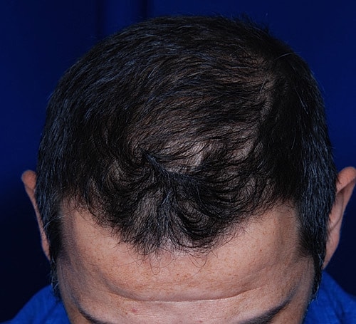 Hair Transplant Before & After