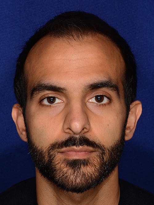 Hair Transplant Before & After