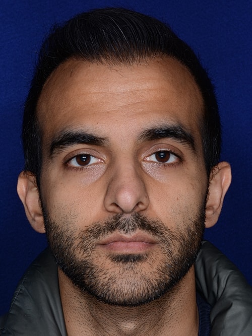 Hair Transplant Before & After