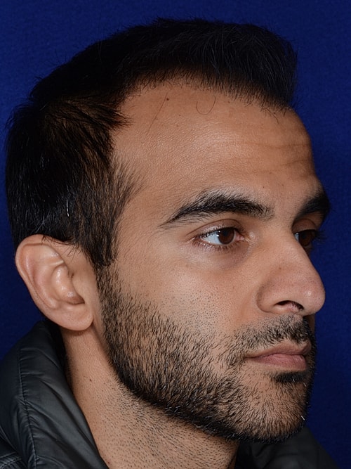 Hair Transplant Before & After
