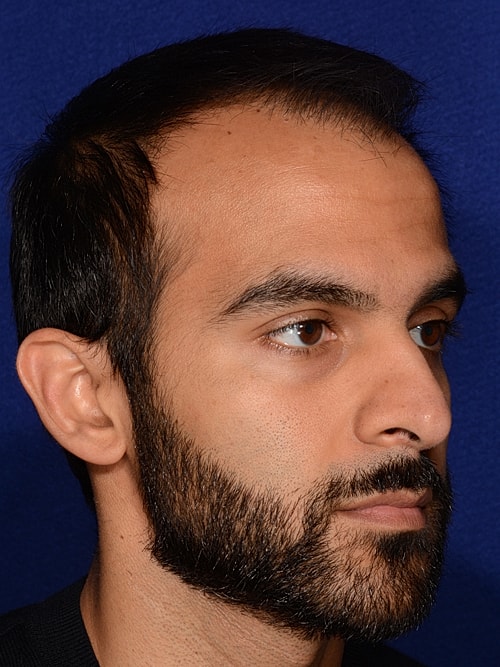 Hair Transplant Before & After