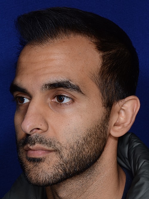 Hair Transplant Before & After