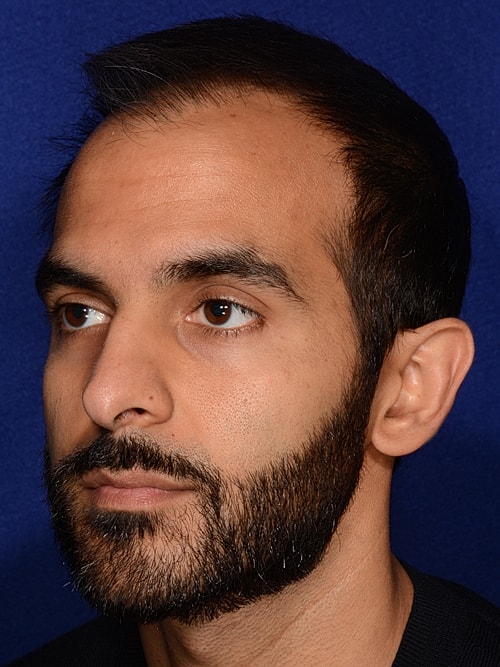 Hair Transplant Before & After