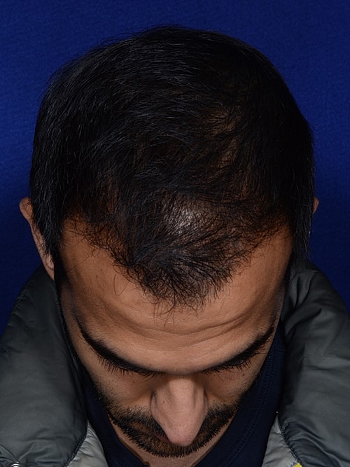 Hair Transplant Before & After