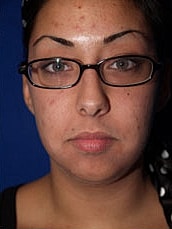 Chin Implant Before & After