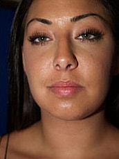 Chin Implant Before & After