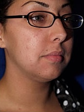 Chin Implant Before & After