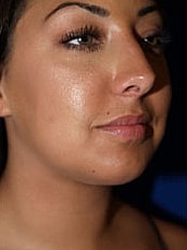 Chin Implant Before & After