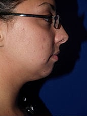 Chin Implant Before & After