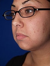 Chin Implant Before & After