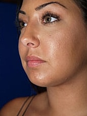 Chin Implant Before & After