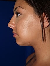 Chin Implant Before & After