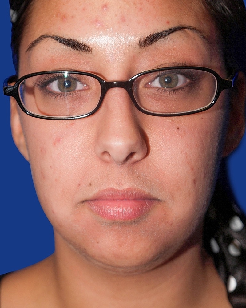 Chin Implant Before & After