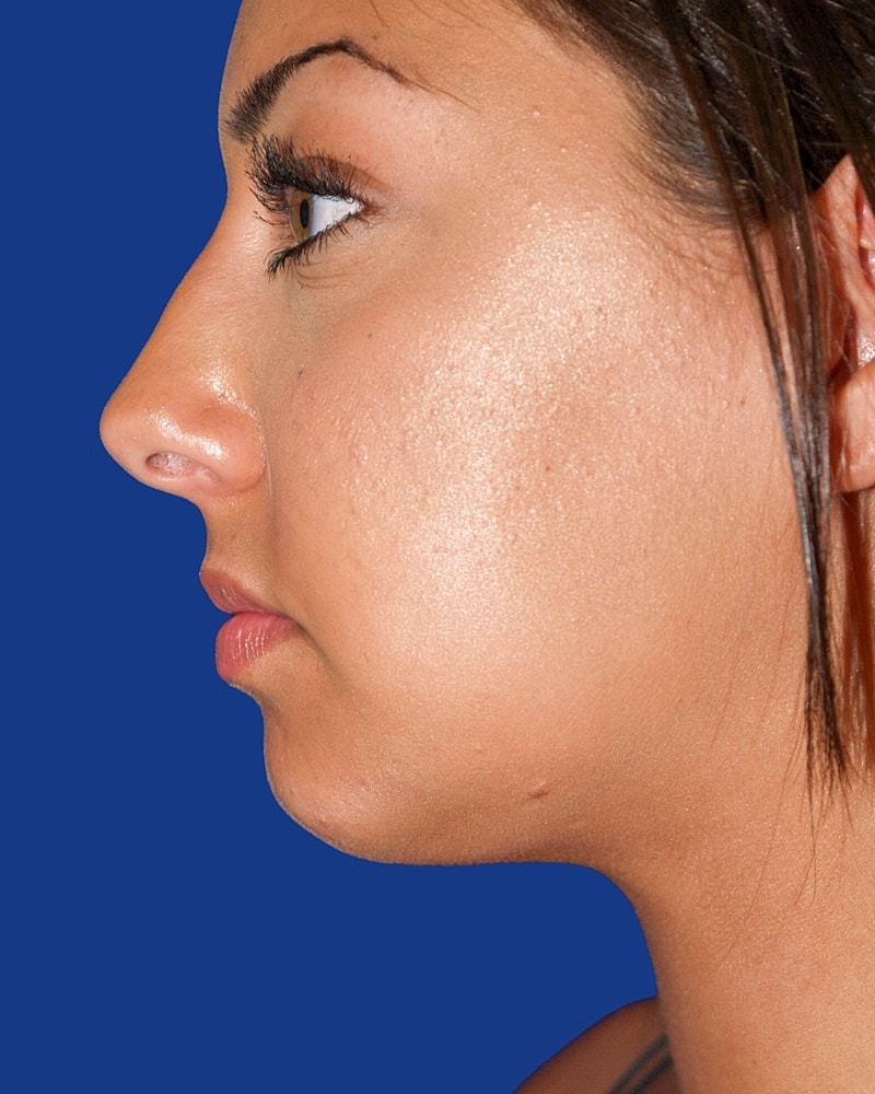 Chin Implant Before & After